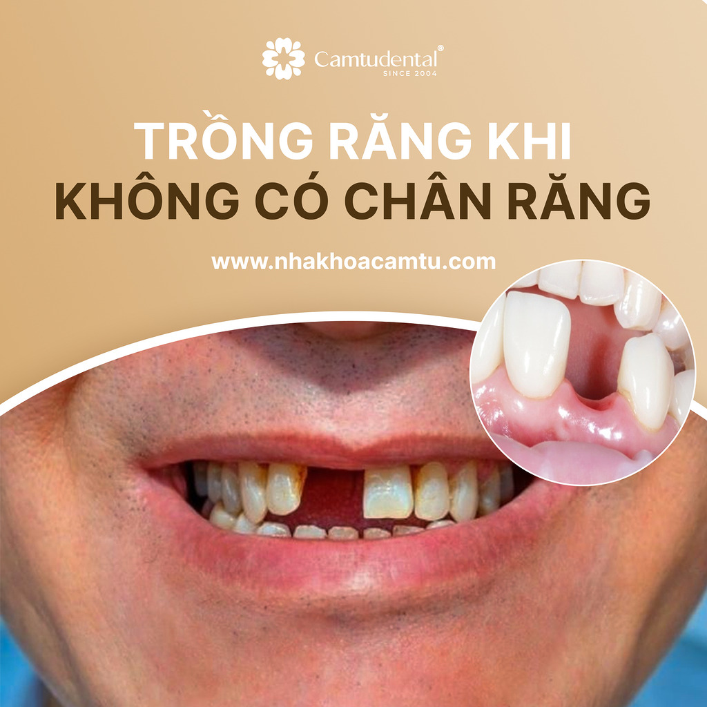Trồng răng không có chân răng được không