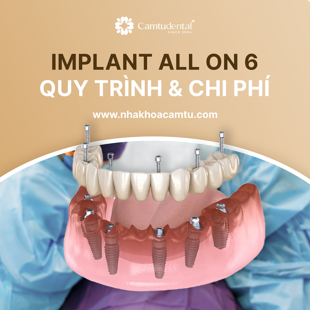 implant all on 6