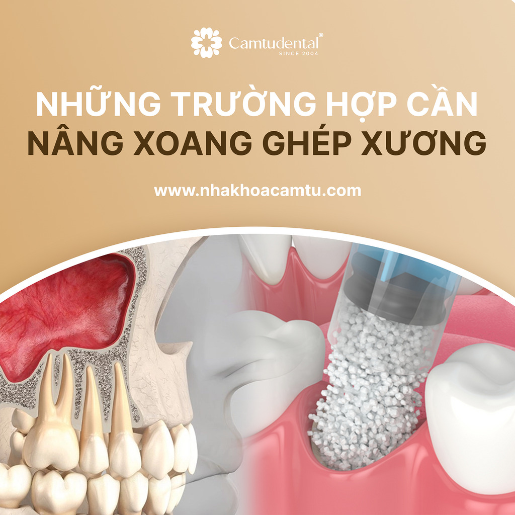Những Trường Hợp Cần Nâng Xoang Ghép Xương