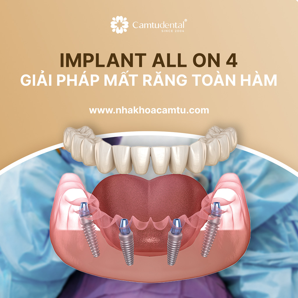 Trồng Răng Implant All On 4 Cho Người Mất Răng Toàn Hàm