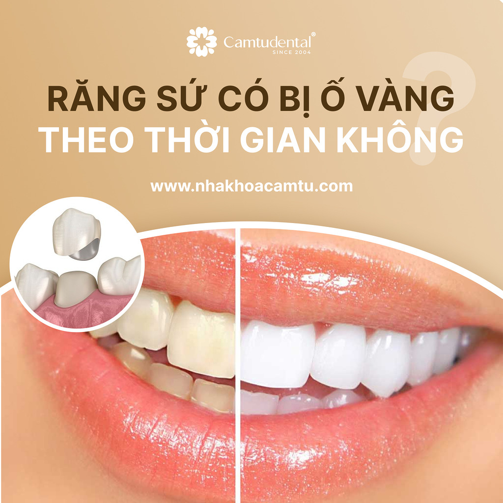 răng sứ bị ố vàng theo thời gian