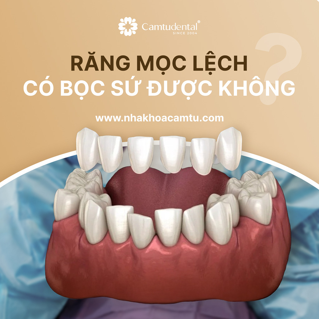 răng mọc lệch có bọc răng sứ được không