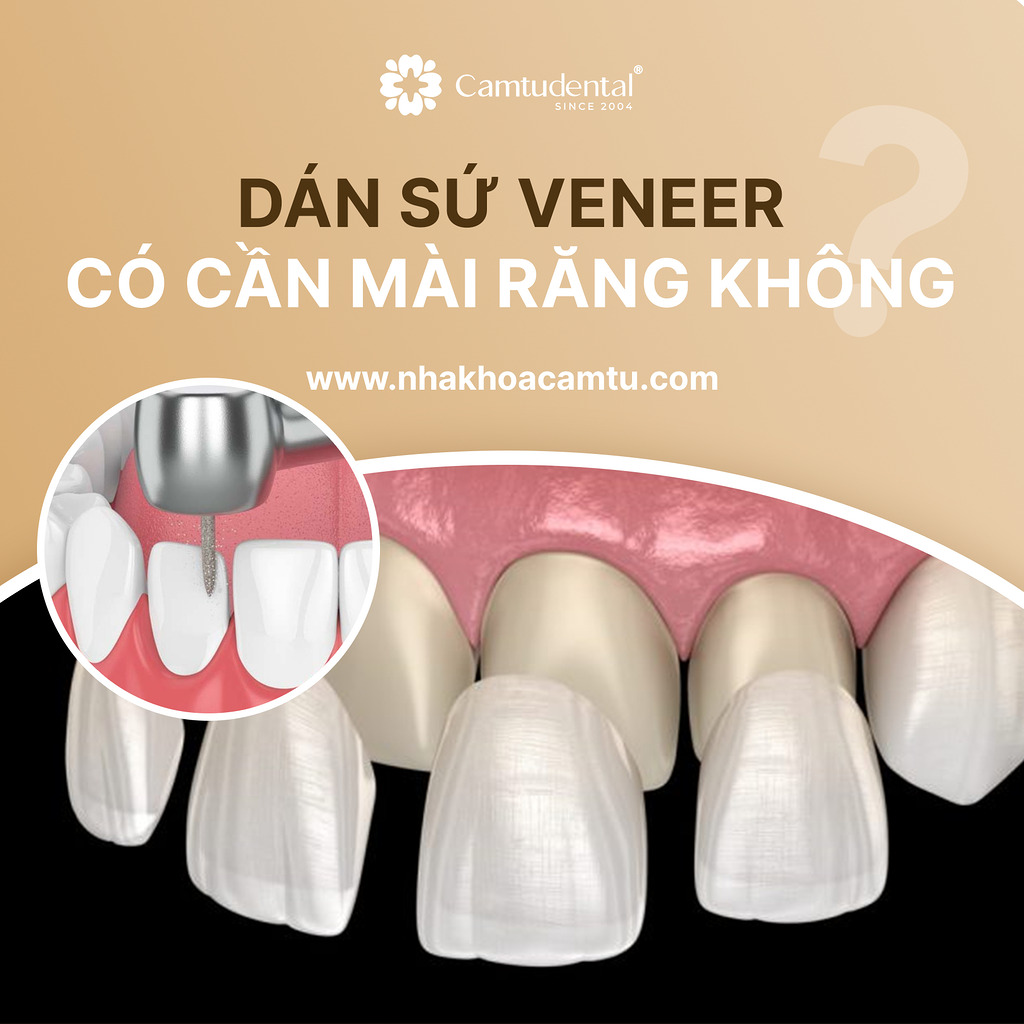 dán sứ veneer có cần mài răng không