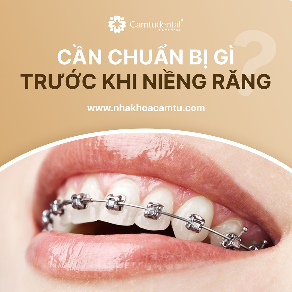 cần chuẩn bị gì trước khi niềng răng