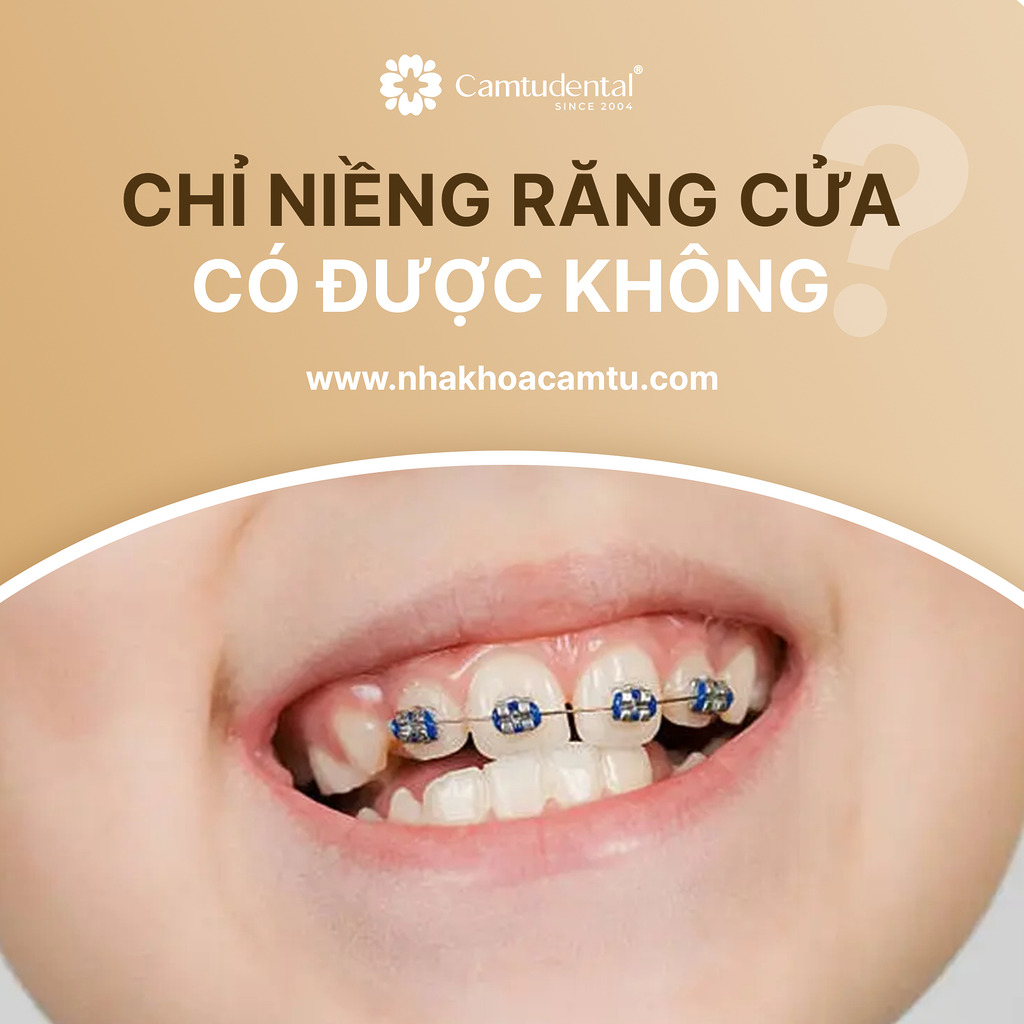 chỉ niềng răng cửa có sao khong