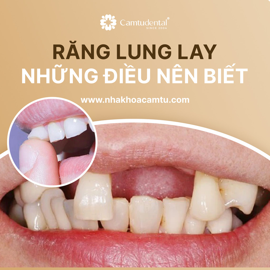 những điều cần biết về răng lung lay