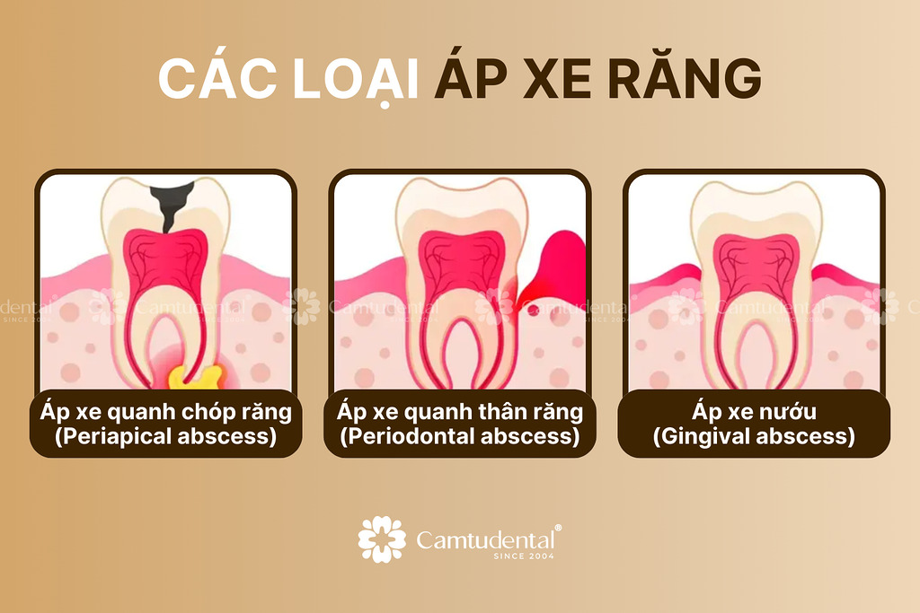 các loại áp xe răng