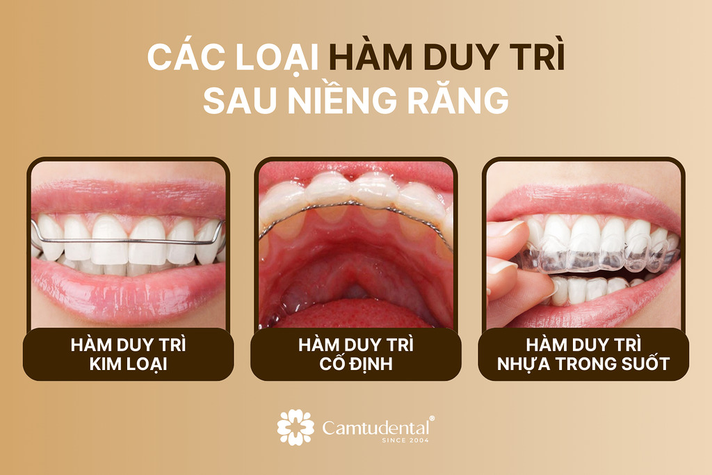 Những điều cần chuẩn bị trước khi niềng răng, bạn có biết? 13 các loại hàm duy trì sau khi niềng răng: hàm duy trì cố định, hàm duy trì kim loại, hàm duy trì nhựa trong suốt