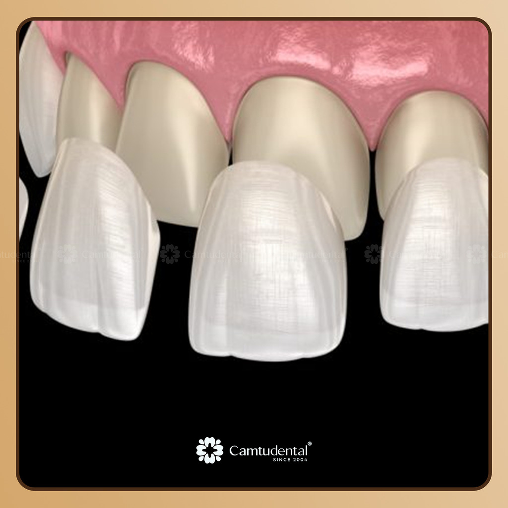 Dán sứ veneer là gì? Có mài răng không? 2 dán sứ veneer
