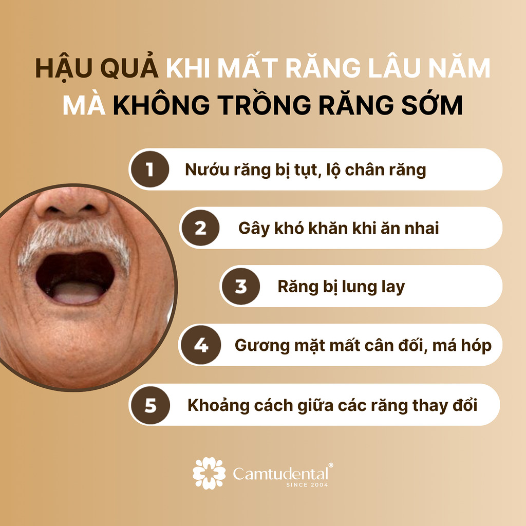 những hậu quả khi mất răng lâu năm mà không trồng răng implant sớm