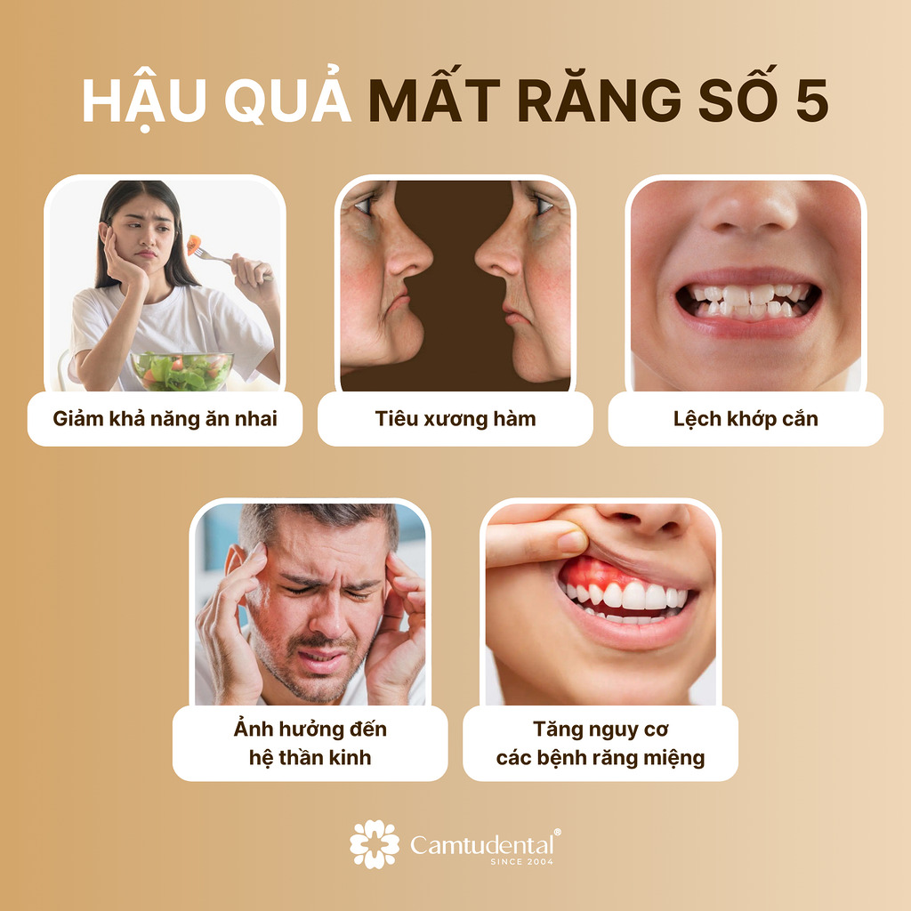 5 hậu quả khi mất răng số 5