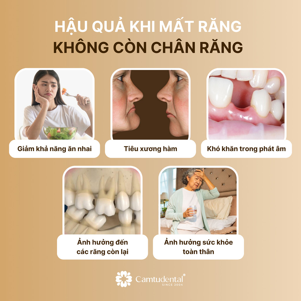 Hậu quả nghiêm trọng khi mất răng không còn chân răng