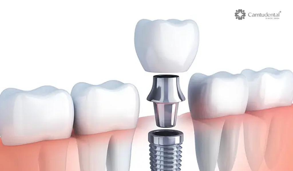 trồng răng implant răng số 5