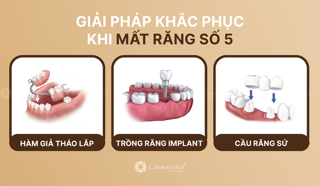3 Giải pháp phục hồi khi mất răng số 5