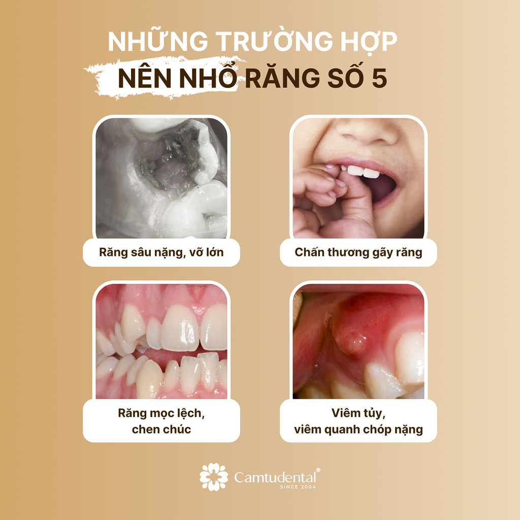 4 trường hợp nên nhổ răng số 5