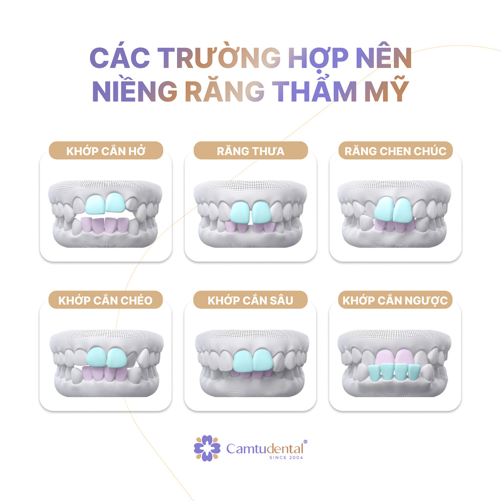 Niềng Răng Thẩm Mỹ: Tất Tần Tật Những Điều Cần Biết Về Niềng Răng 7 các trường hợp nên niềng răng thẩm mỹ
