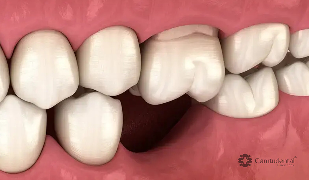 Trồng răng không có chân răng