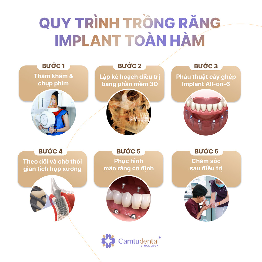 Quy trình cấy ghép Implant All on 6 tại Nha khoa Cẩm Tú