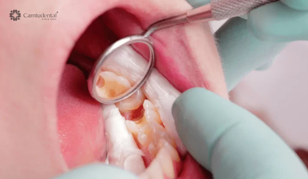 Viêm Tủy Răng Sữa: Nguyên Nhân, Dấu Hiệu và Cách Phòng Ngừa 3 khoang miệng trẻ em