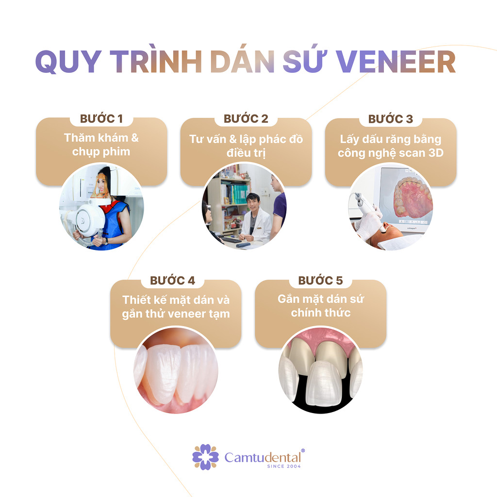 Dán sứ veneer là gì? Có mài răng không? 4 quy trình dán sứ veneer tại nha khoa Cẩm Tú