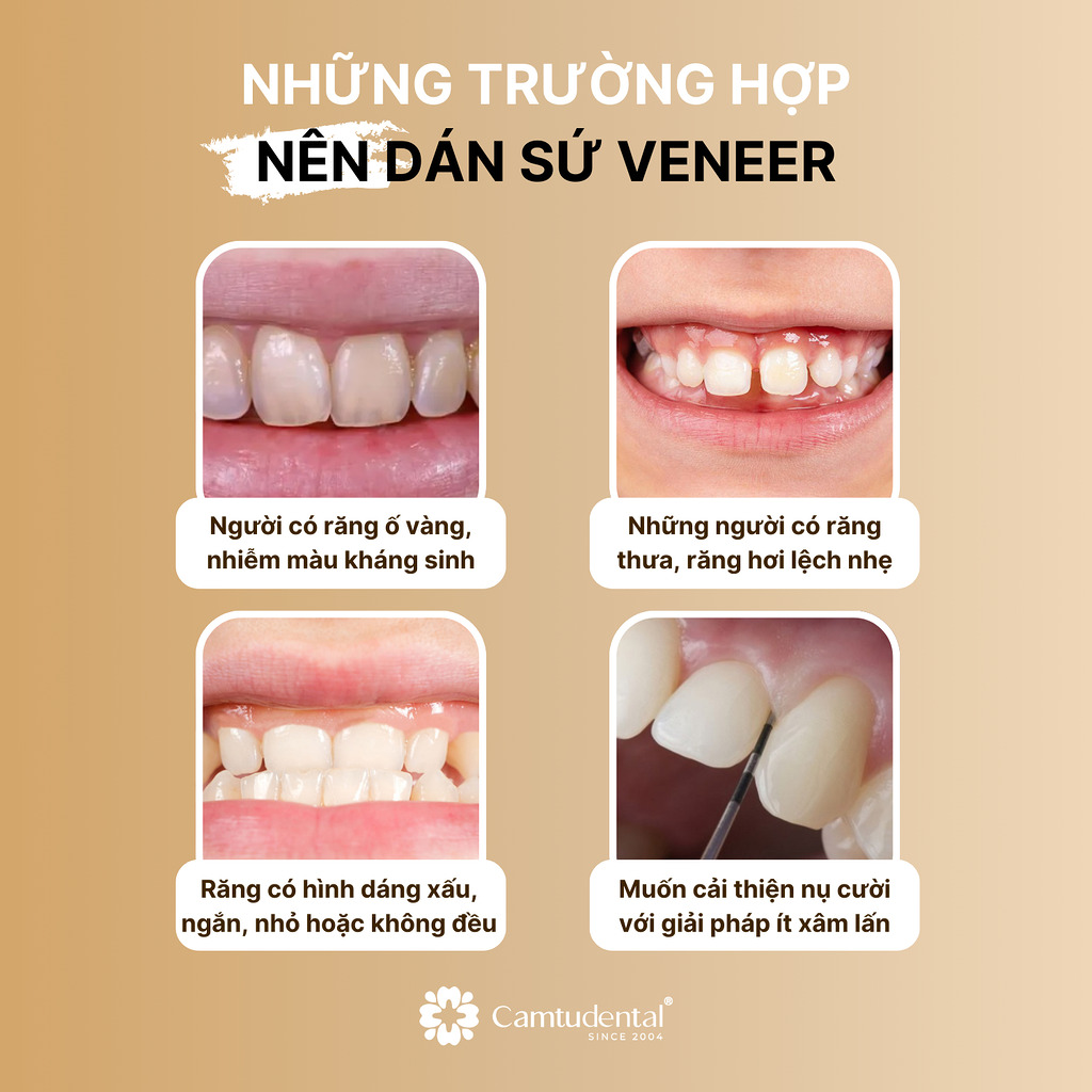 Dán sứ veneer là gì? Có mài răng không? 3 4 trường hợp nên dán sứ veneer