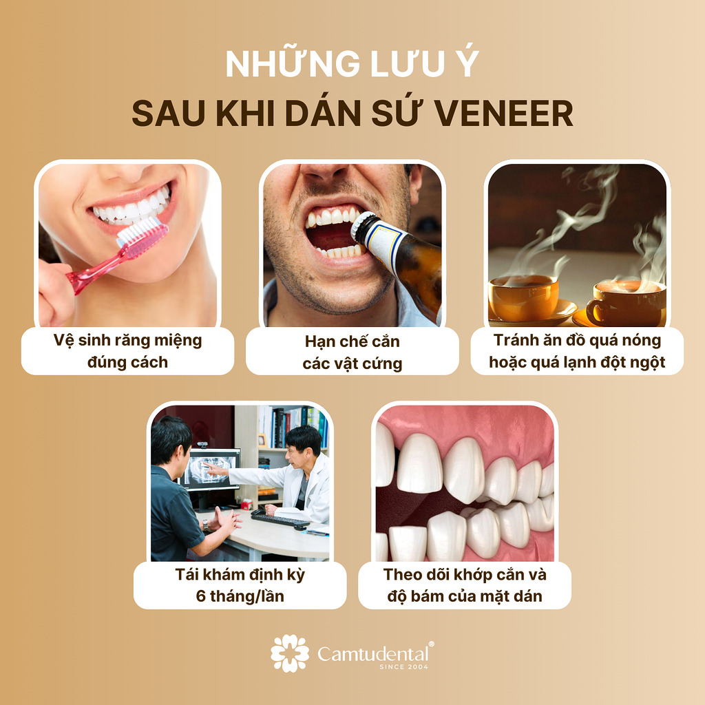 Dán sứ veneer là gì? Có mài răng không? 5 5 lưu ý sau khi dán sứ veneer