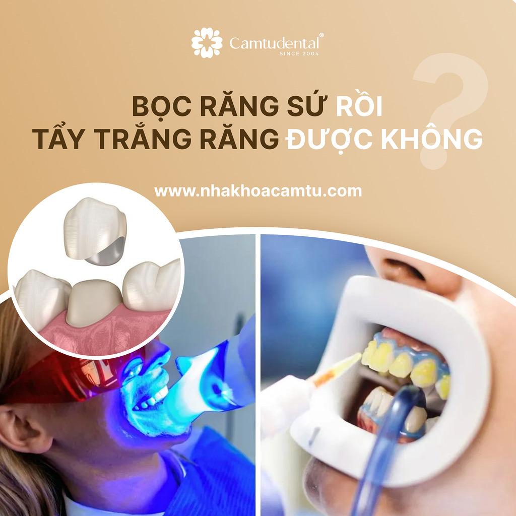 bọc răng sứ rồi có tẩy trắng răng được không