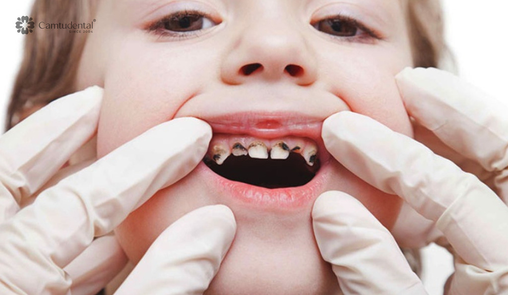 Viêm Tủy Răng Sữa: Nguyên Nhân, Dấu Hiệu và Cách Phòng Ngừa 4 Sâu răng gây viêm tủy răng
