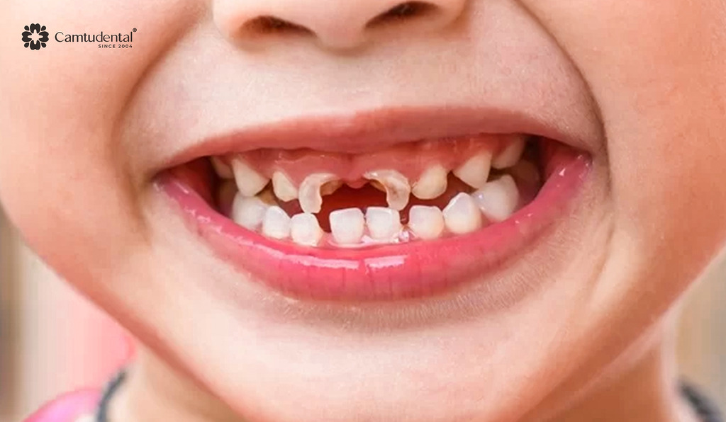 Viêm Tủy Răng Sữa: Nguyên Nhân, Dấu Hiệu và Cách Phòng Ngừa 5 trẻ bị gãy răng cửa