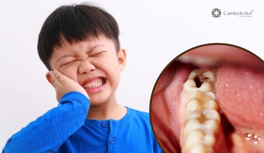 Viêm Tủy Răng Sữa: Nguyên Nhân, Dấu Hiệu và Cách Phòng Ngừa 6 cậu bé bị đau răng do viêm tủy răng sữa