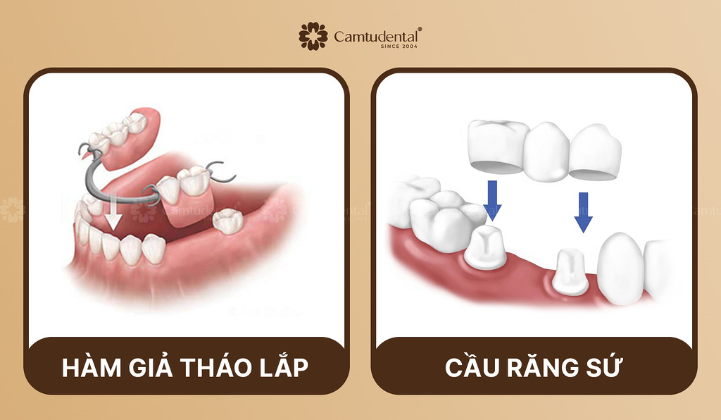 hình ảnh so sánh hàm giả tháo lắp và cầu răng sứ