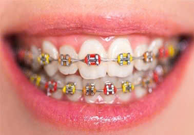 Niềng Răng Thẩm Mỹ: Tất Tần Tật Những Điều Cần Biết Về Niềng Răng 8 niềng răng mắc cài kim loại