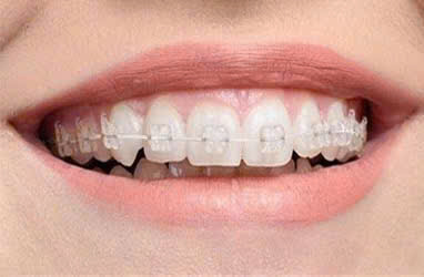 Những điều cần chuẩn bị trước khi niềng răng, bạn có biết? 8 niềng răng mắc cài sứ