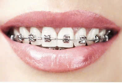 Niềng Răng Thẩm Mỹ: Tất Tần Tật Những Điều Cần Biết Về Niềng Răng 10 niềng răng mắc cài tự buộc