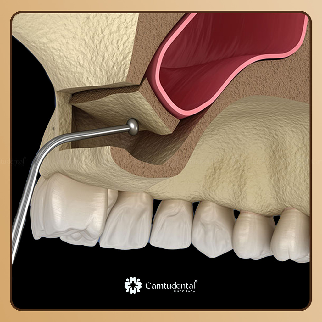 nang xoang ho - Những Trường Hợp Cần Nâng Xoang Ghép Xương, Bạn Có Biết? - Hệ thống Nha khoa Cẩm Tú