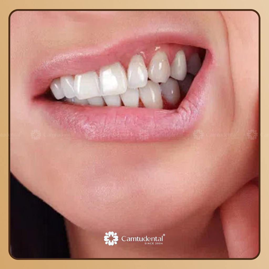 nghiến răng khiến răng bị lung lay