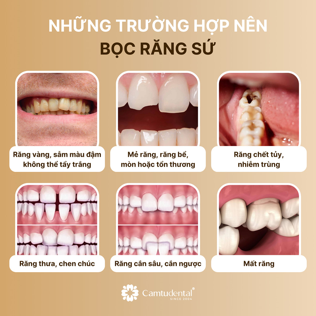Răng Mọc Lệch Có Bọc Sứ Được Không? 2 những trường hợp nên bọc răng sứ