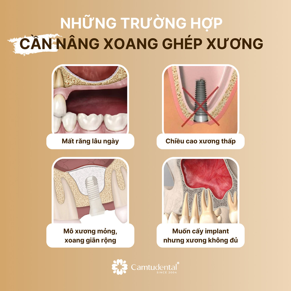 Các trường hợp cần phải nâng xoang ghép xương