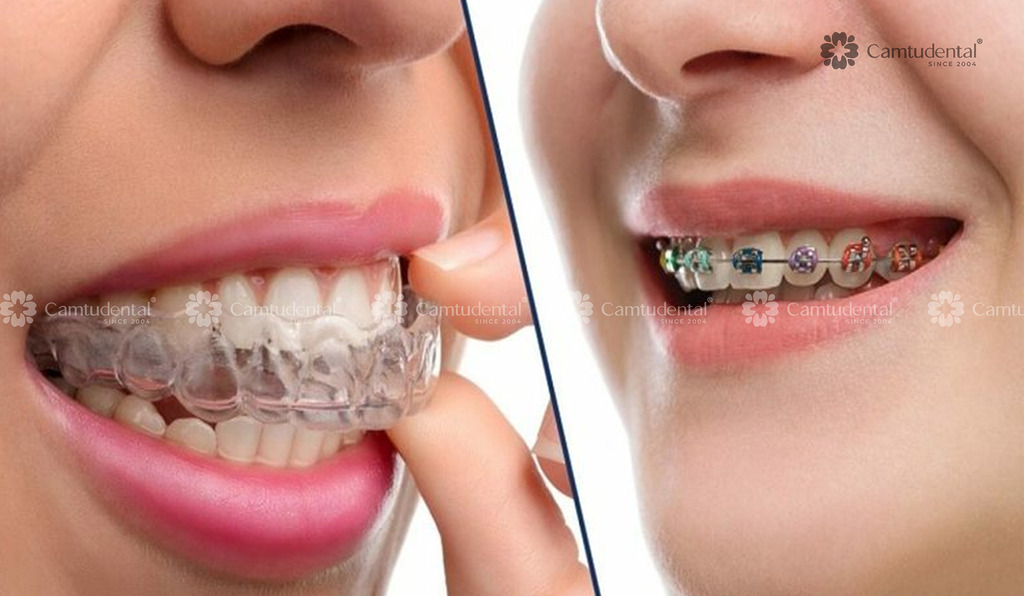 Niềng Răng Thẩm Mỹ: Tất Tần Tật Những Điều Cần Biết Về Niềng Răng 6 niềng răng thẩm mỹ