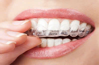 Niềng Răng Thẩm Mỹ: Tất Tần Tật Những Điều Cần Biết Về Niềng Răng 11 niềng răng trong suốt invisalign