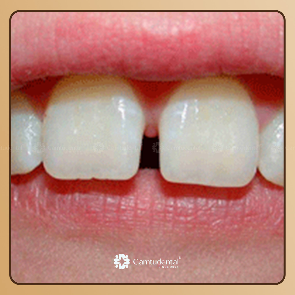 Chỉ Niềng Răng Cửa Có Được Không? Điều Bạn Cần Biết Trước Khi Quyết Định 3 răng cửa bị thưa