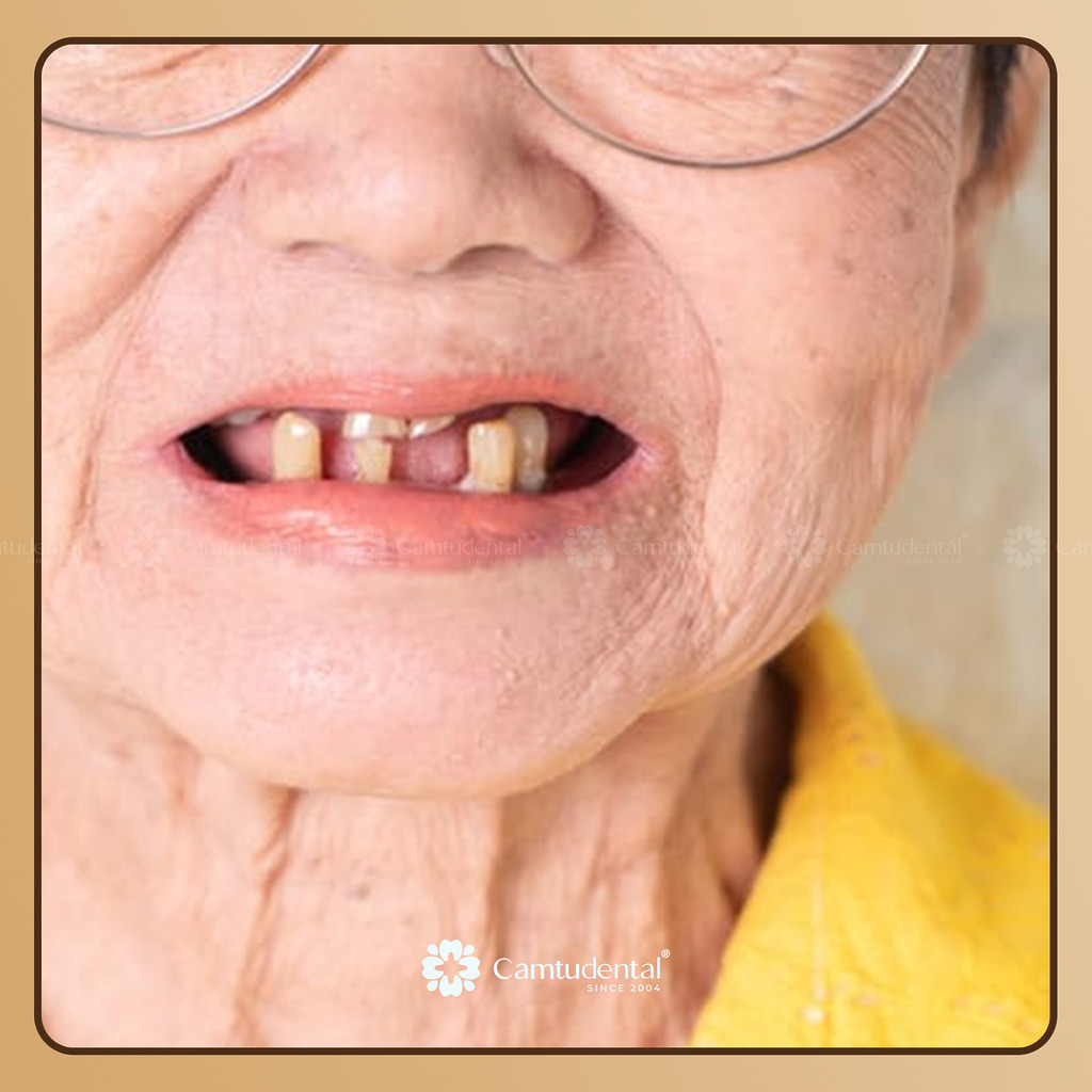 răng lung lay ở người già