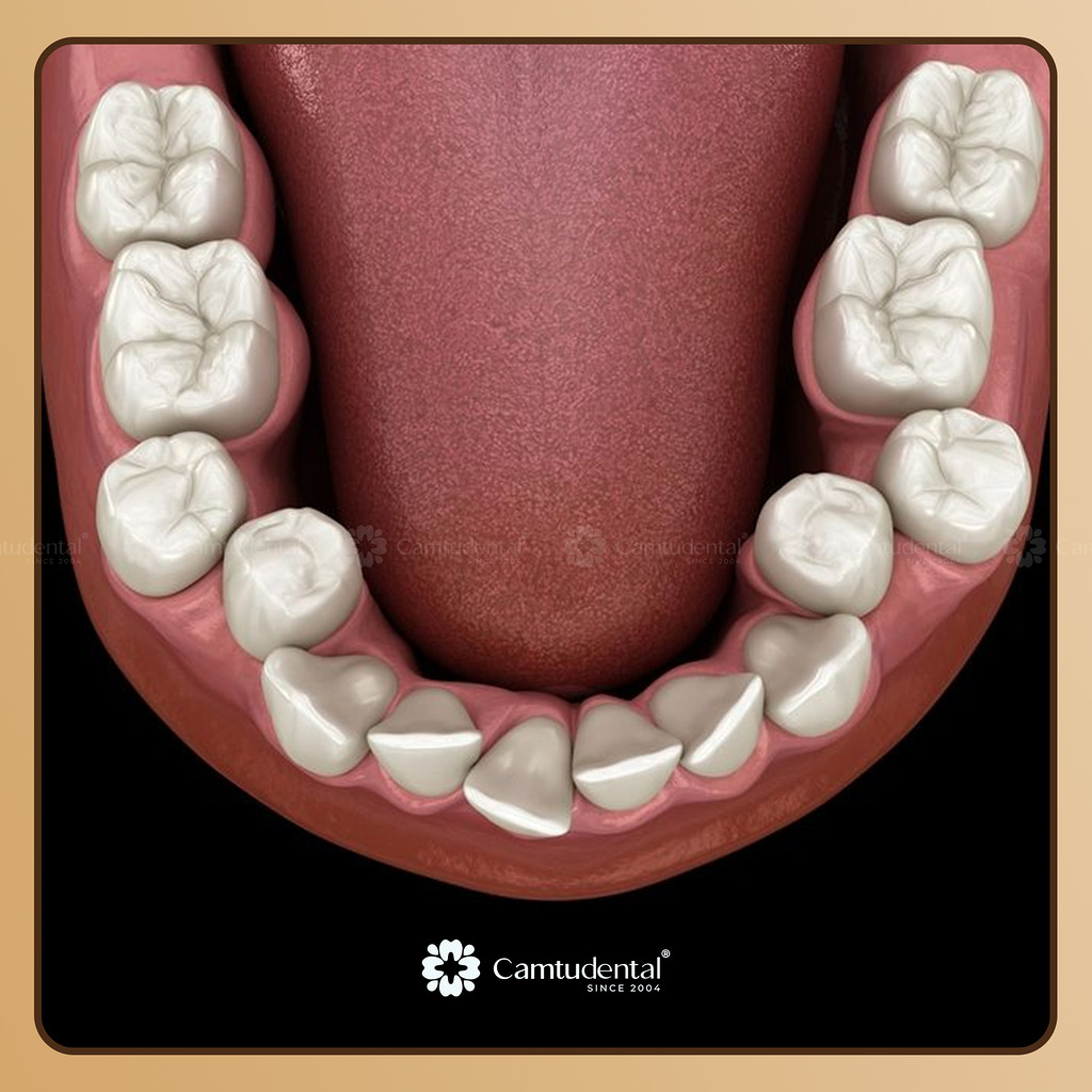 Răng Mọc Lệch Có Bọc Sứ Được Không? 3 răng mọc lệch lộn xộn