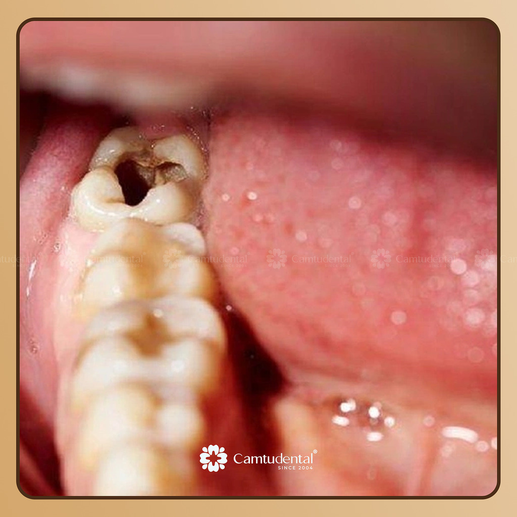 sâu răng khiến răng bị lung lay