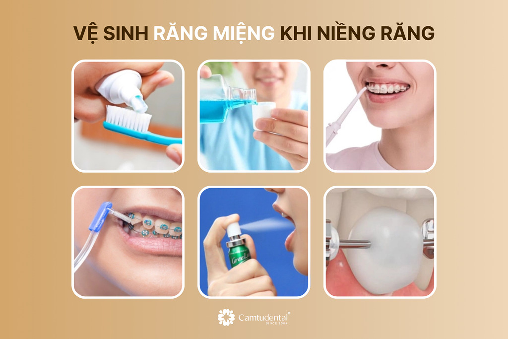 Những điều cần chuẩn bị trước khi niềng răng, bạn có biết? 11 vệ sinh răng miệng khi niềng răng