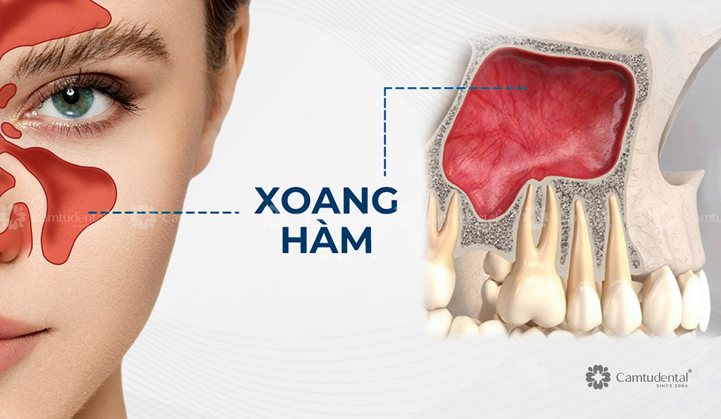 mô phỏng xoang hàm