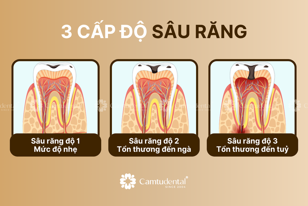 3 cấp độ sâu răng