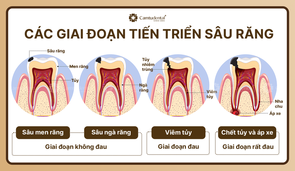 các giai đoạn tiến triển sâu răng