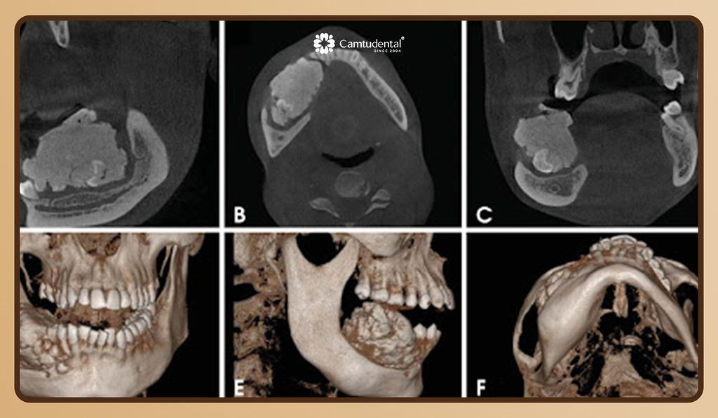 Danh Gia Cau Truc Xuong Ham - Chụp Phim Cone Beam CT Trong Trồng Răng Implant - Hệ thống Nha khoa Cẩm Tú