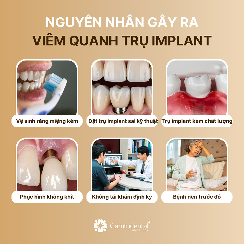 Nguyên Nhân Gây Ra Viêm Quanh Trụ Implant